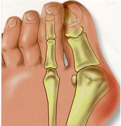 Bunion Surgery Midtown And Downtown Ny Gotham Footcare