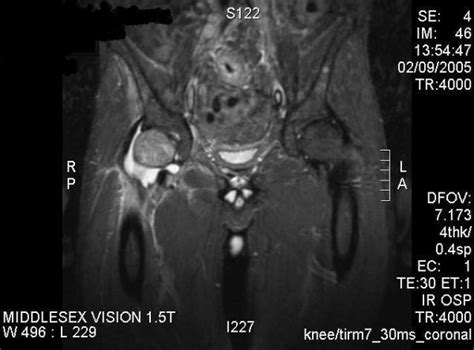 Mri Of The Pelvis Showing Effusion With Soft Tissue Swelling And