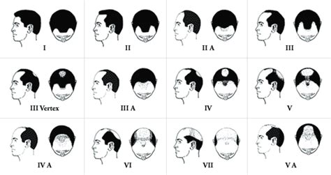How To Tell If Youre Balding Male Sep 23 2019 · 8 Ways To Know If