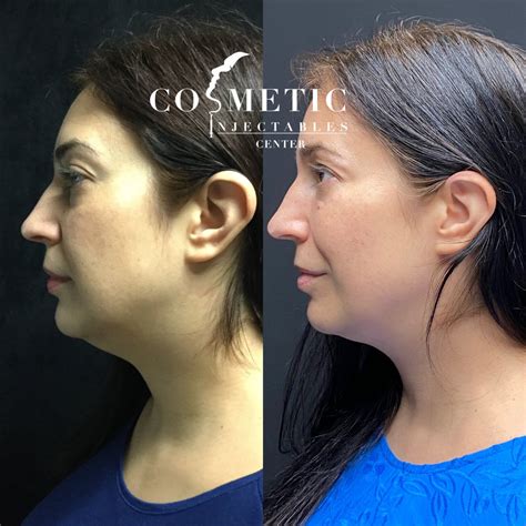 What To Expect With Kybella Before And After Your Procedure Cosmetic
