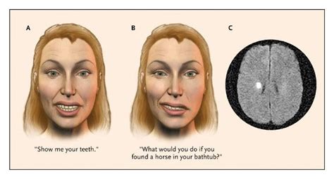 Bells Palsy Nejm