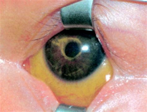 Eye Infection Yellow Ring