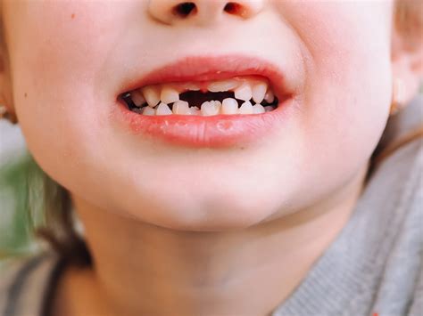 When Do Kids Start Losing Teeth Gentle Dental