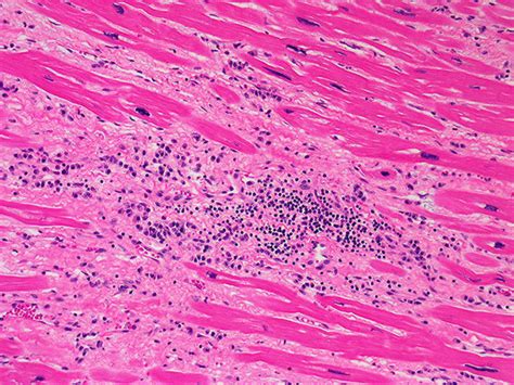 Myocarditis, also known as inflammatory cardiomyopathy, is inflammation of the heart muscle. 101A Myocarditis