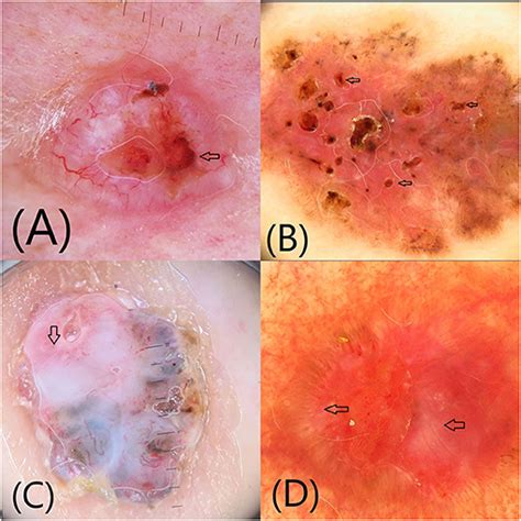 Frontiers Role Of Dermoscopy In The Assessment Of Basal Cell Carcinoma