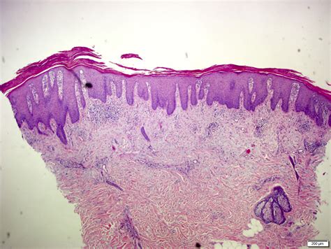 Pathology Outlines Psoriasis