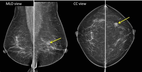 Hookwire Localisation Of Breast Lesion Radiology Cases