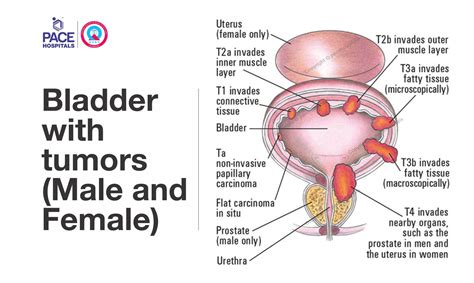 Transurethral Resection Of Bladder Tumour TURBT