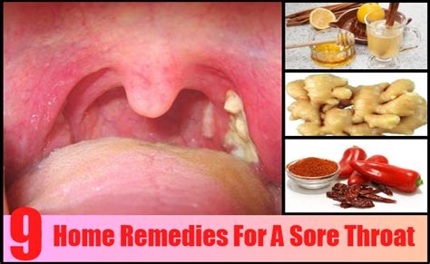 A sore throat caused by a viral infection usually lasts five to seven days and doesn't require medical treatment. 9 Top Home Remedies For A Sore Throat - Natural Treatments ...