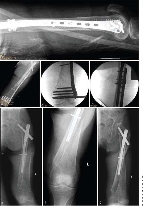 Minimally Invasive Periprosthetic Plate Osteosynthesis Using The