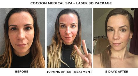 Laser 3d By Quanta Skin Rejuvenation Cocoon