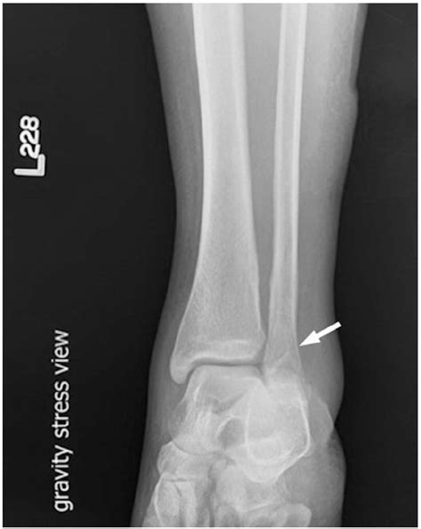Weber B Distal Fibular Fracture Diagnosed By Point Of Care Ultrasound