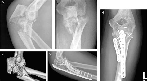 Combined Posterior And Medial Plate Fixation Of Complex Proximal Ulna