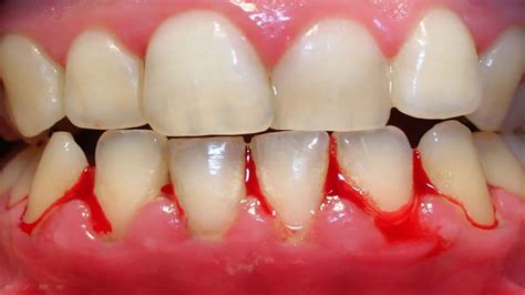 Why Do I Bleed On Brushing My Teeth Uganda Dental Association