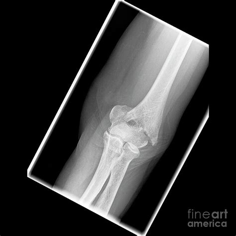 Elbow Fracture Photograph By Science Photo Library
