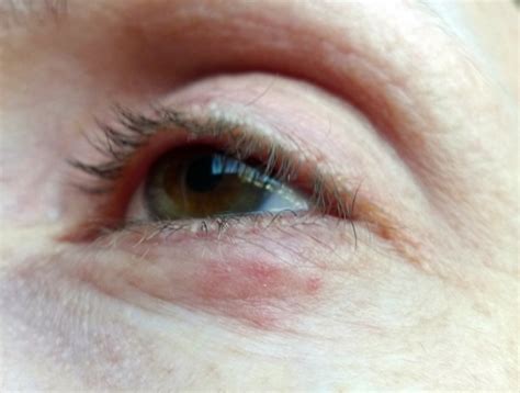 Small Red Pimples Below Lower Eyelid Dermatitis And Eczema Patient