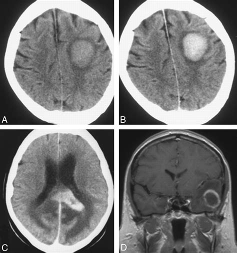Ct And Mr Imaging Features Of Primary Central Nervous System Lymphoma