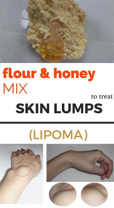 Flour And Honey Mix To Get Rid Of Skin Lumps Lipoma Treat Skin