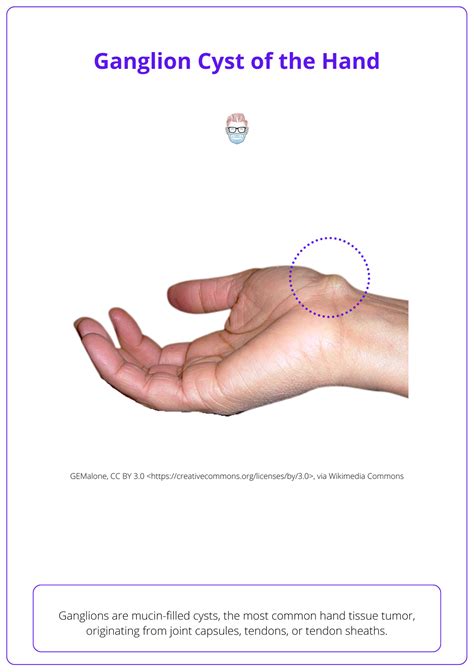 Ganglion Cysts Of The Hand And Wrist Diagnosis And Treatment