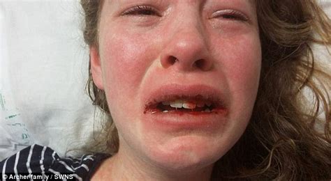 Mystery Illness Leaves Gloucestershire Girl Bleeding From The Mouth