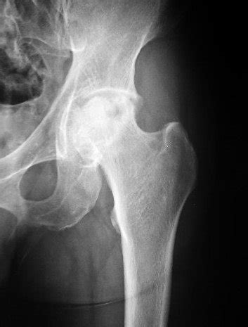 Results of core decompression, grafting and osteotomy. Avascular Necrosis of the Hip Joint | Dr HC Chang