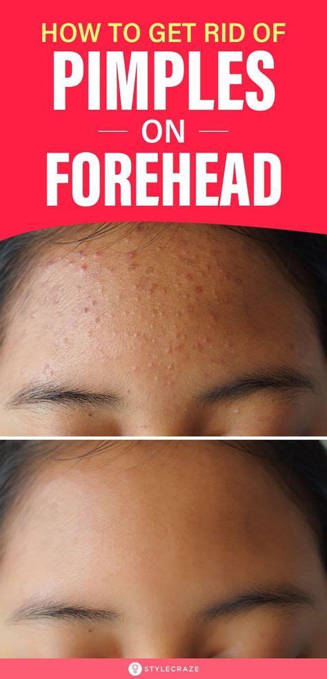 How To Get Rid Of Pimples On Forehead Pimples On Forehead Pimples On