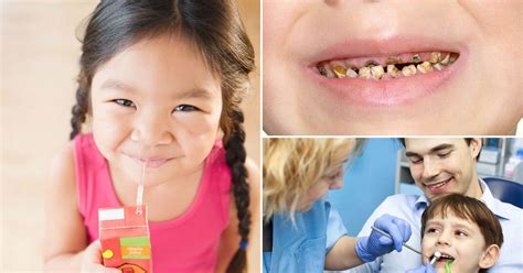 Half Of Children Have Tooth Decay With Poverty And Sugar Blamed For