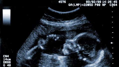 20 Weeks Pregnant With Twins Ultrasound