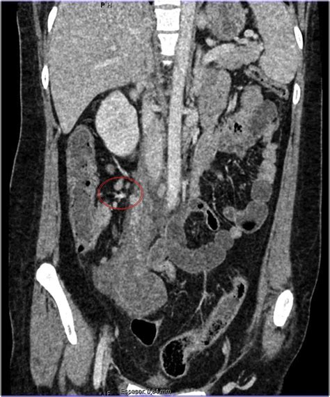 Abdominal Ct Scan With Iv Contrast In Coronal Plane Enlarged Right