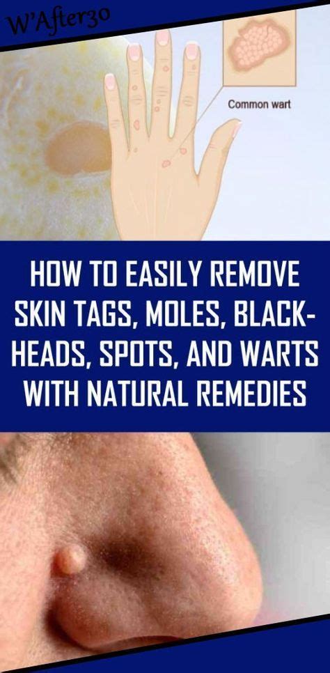 How To Easily Remove Skin Tags Moles Blackheads Spots And Warts