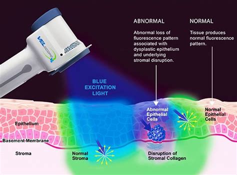 Tissue Fluorescence Visualization Burnaby Dental Group