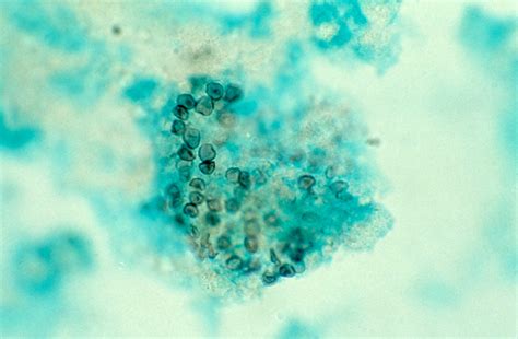 Lung Pneumocystis Carinii Pneumonia Pcp With Hiv Wellcome Collection