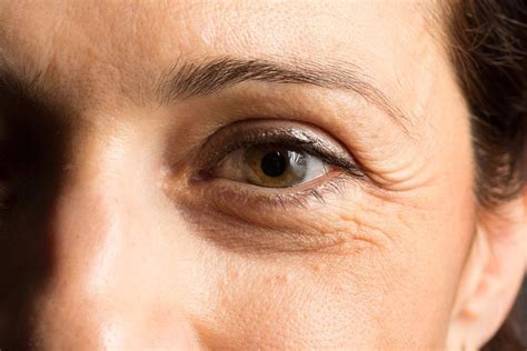 Eye Bag Treatment Dr Haus Dermatology