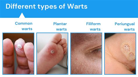 Warts Causes Symptoms Diagnosis And Treatment