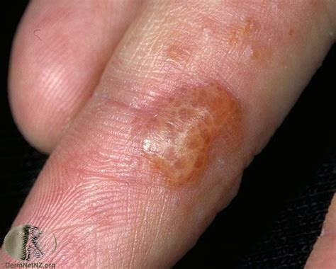Hand Eczema Blisters Dorothee Padraig South West Skin Health Care