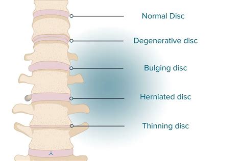 Herniated Disc Symptoms Causes And Treatments