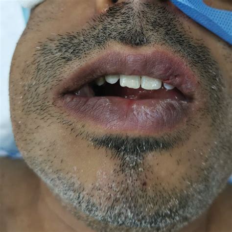 Extraoral Photograph Of The Patient Showing Swelling On Right Side Of