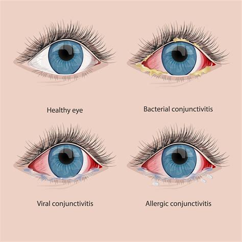 146 Images Viral Conjunctivitis For Free Myweb