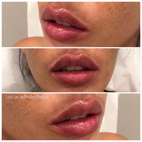 Lips By Aniaesthetics Lipfiller Lipinjections Perfectlips Lips