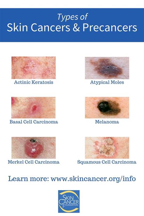 Pin On Skin Cancer