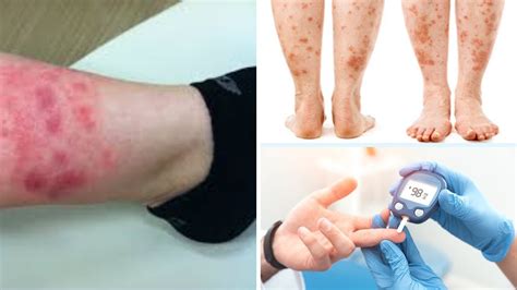 What Causes The Leg Rash In Diabetes Diabetic Rash Treatment All