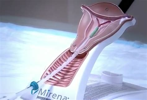 Compensation For Mirena Iud Victims Requiring Removal Surgery Sign Up Now