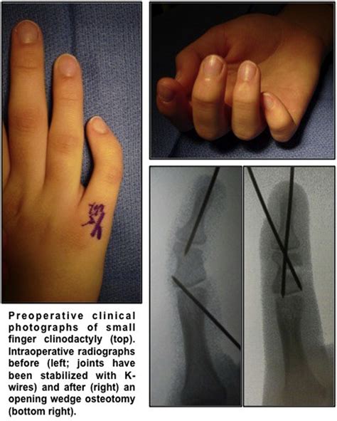 Outcomes Of Opening Wedge Osteotomy To Correct Angular Deformity In