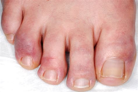 How To Treat Chilblains At Home The Footcare Clinic