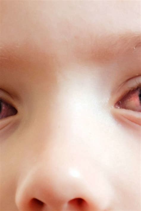 Pink Eye In Toddlers Symptoms Diagnosis And Treatment