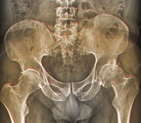 Osteoarthritis Of The Hip X Ray Stock Image F Science