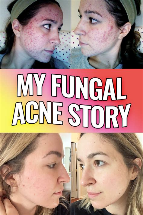 The Secret That Cleared My Severe Hormonal Cystic Itchy Adult Acne After Years Part