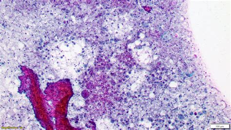 Pathology Outlines Nonproliferative Fibrocystic Changes