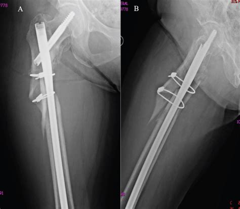 Subtrochanteric Fracture Non Union With Implant Failure Managed With