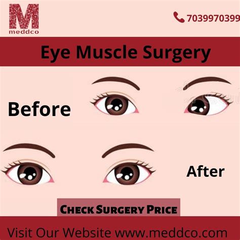 What Is The Purpose Of Eye Muscle Surgery